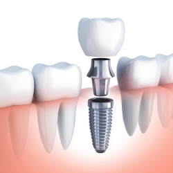 illustration - dental implant compared to natural teeth